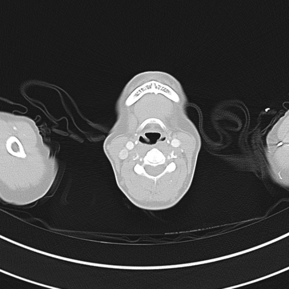 Adenocystic carcinoma of the trachea (Radiopaedia 47677-52525 Axial lung window 17).jpg