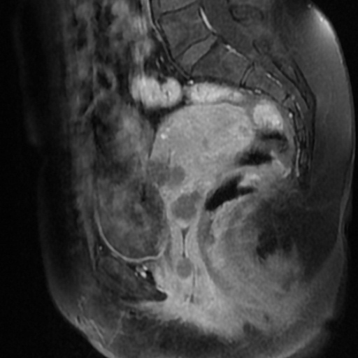 File:Adenoma malignum of cervix (Radiopaedia 66441-75705 Sagittal T1 C+ fat sat 11).jpg