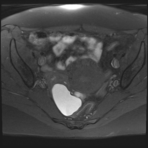 File:Adenomyosis and endometriotic cysts (Radiopaedia 82300-96367 Axial T1 fat sat 17).jpg