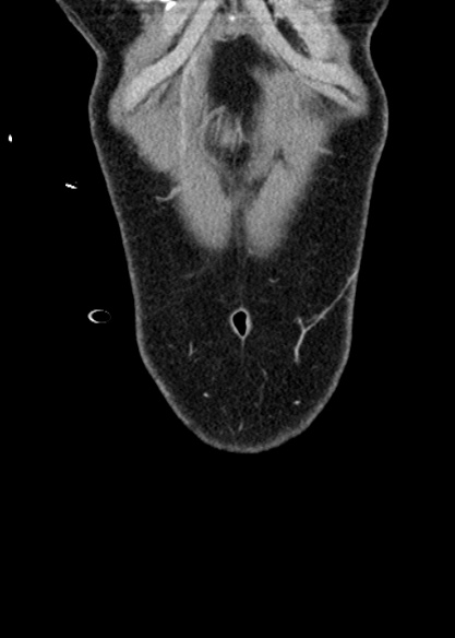 Adhesional small bowel obstruction (Radiopaedia 48397-53305 Coronal C+ portal venous phase 30).jpg
