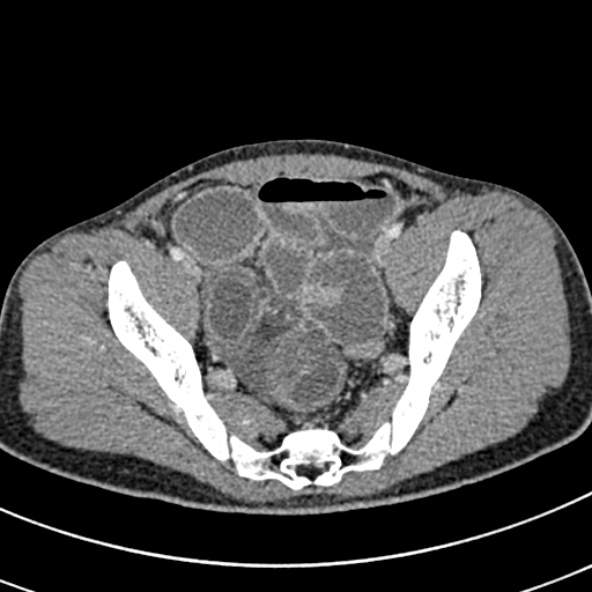 Adhesional small bowel obstruction (Radiopaedia 52107-57980 Axial C+ portal venous phase 108).jpg