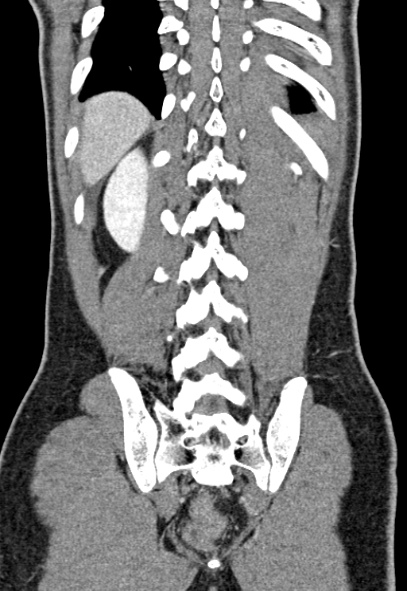 Adhesional small bowel obstruction (Radiopaedia 52107-57980 Coronal C+ portal venous phase 68).jpg