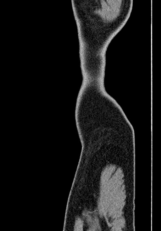 Adhesional small bowel obstruction (Radiopaedia 58900-66131 Sagittal C+ portal venous phase 2).jpg