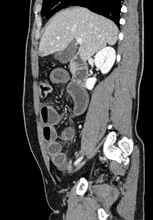 Adhesional small bowel obstruction (Radiopaedia 58900-66131 Sagittal C+ portal venous phase 89).jpg