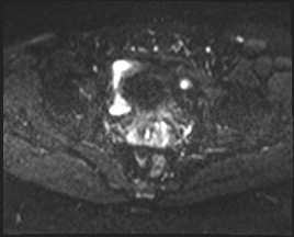 Adnexal multilocular cyst (O-RADS US 3- O-RADS MRI 3) (Radiopaedia 87426-103754 Axial DWI 17).jpg