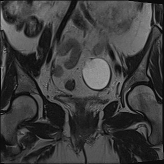 File:Adnexal multilocular cyst (O-RADS US 3- O-RADS MRI 3) (Radiopaedia 87426-103754 Coronal T2 16).jpg