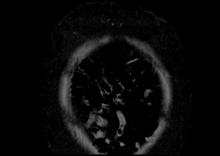 File:Adrenal cortical carcinoma (Radiopaedia 64017-72769 Coronal C+ portal venous phase 4).jpg