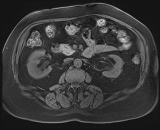 Adrenal cortical carcinoma (Radiopaedia 64017-72770 Axial T1 fat sat 45).jpg