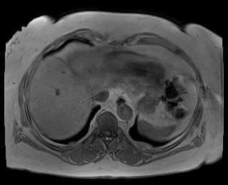 File:Adrenal cortical carcinoma (Radiopaedia 64017-72770 Axial T1 in-phase 4).jpg
