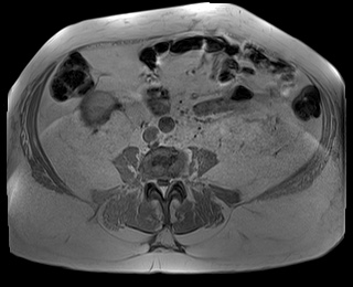 File:Adrenal cortical carcinoma (Radiopaedia 64017-72770 Axial T1 in-phase 61).jpg