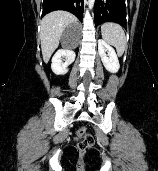 Adrenal cortical carcinoma (Radiopaedia 84882-100379 Coronal C+ portal venous phase 46).jpg