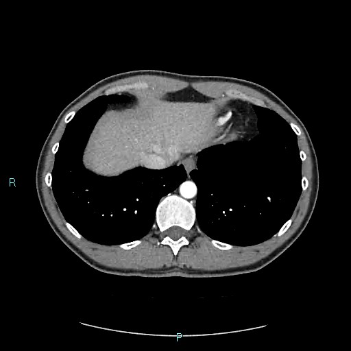 File:Adrenal cystic lymphangioma (Radiopaedia 83161-97534 Axial C+ arterial phase 13).jpg