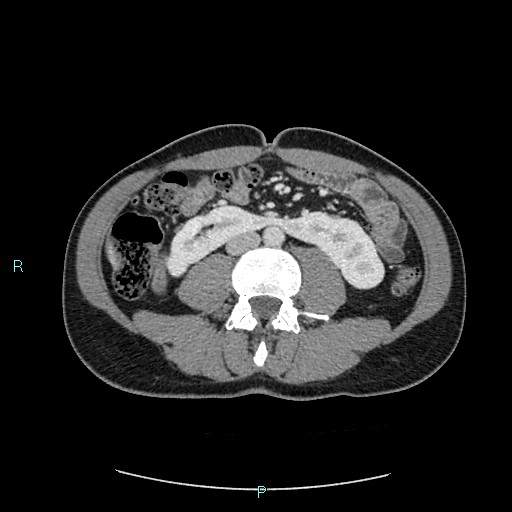 Adrenal cystic lymphangioma (Radiopaedia 83161-97534 Axial C+ portal venous phase 53).jpg