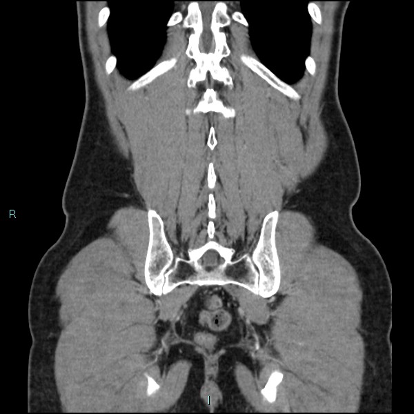 File:Adrenal cystic lymphangioma (Radiopaedia 83161-97534 Coronal C+ portal venous phase 64).jpg