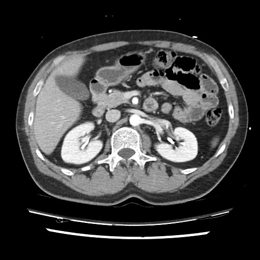 File:Adrenal gland trauma (Radiopaedia 81351-95078 Axial Dual bolus trauma C+ 70).jpg