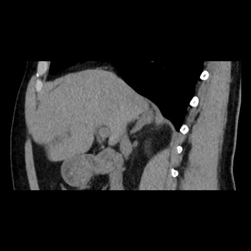 Adrenal gland trauma (Radiopaedia 81351-95079 Sagittal non-contrast 39).jpg