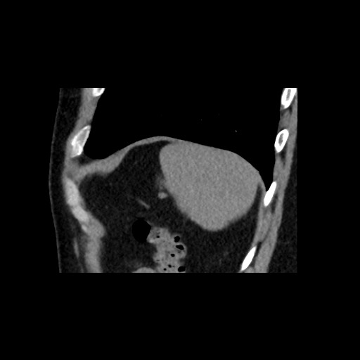 Adrenal gland trauma (Radiopaedia 81351-95079 Sagittal non-contrast 87).jpg
