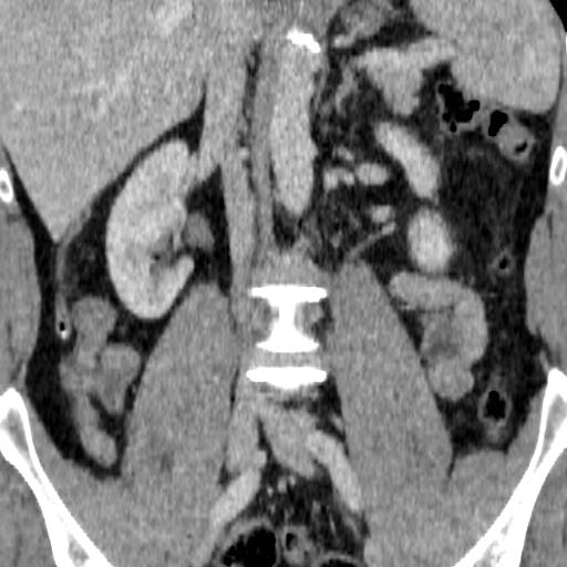 File:Adrenal glands (normal CT anatomy) (Radiopaedia 16570-105725 Coronal 2).jpg