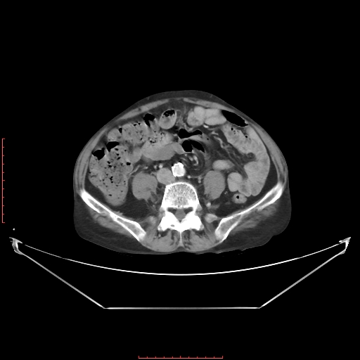 File:Adrenal hemangioma (Radiopaedia 68923-78668 Axial C+ portal venous phase 46).jpg