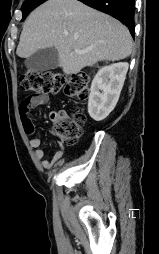 Adrenal lymphoma (Radiopaedia 73730-84529 Sagittal C+ portal venous phase 26).jpg