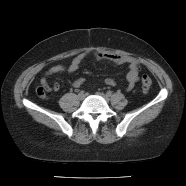 Adrenal myelolipoma (Radiopaedia 43401-46759 Axial non-contrast 59).jpg