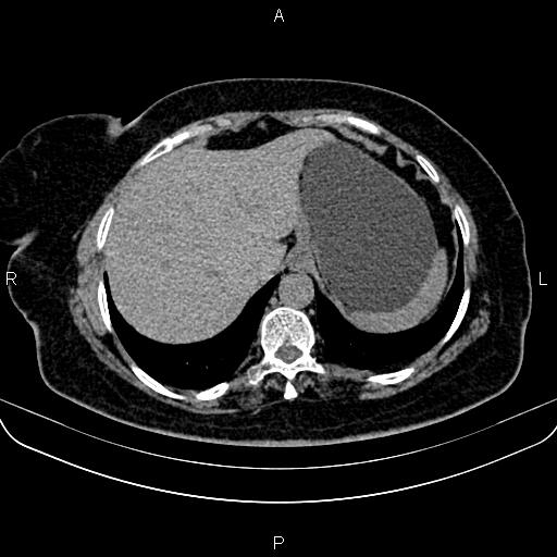 Adrenal myelolipoma (Radiopaedia 82742-96986 Axial non-contrast 20).jpg
