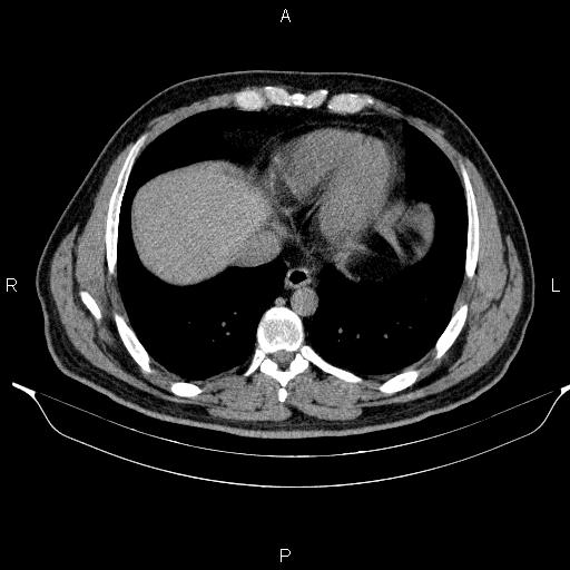 File:Adrenal myelolipoma (Radiopaedia 84321-99619 Axial non-contrast 12).jpg