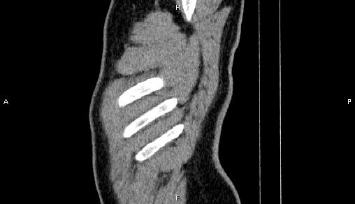 Adrenal myelolipoma (Radiopaedia 84321-99619 Sagittal non-contrast 107).jpg