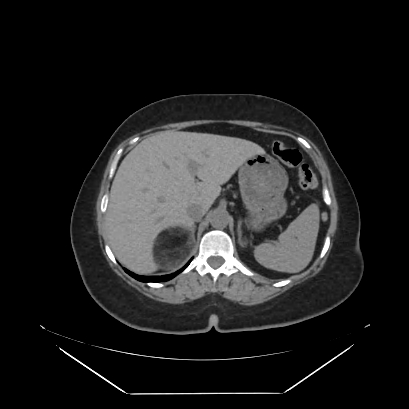 Adrenal myelolipoma - MRI (Radiopaedia 83249-97647 Axial non-contrast 11).jpg