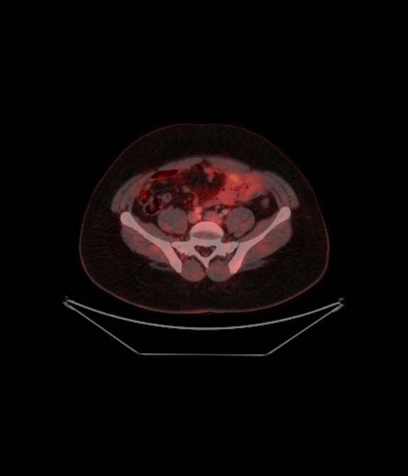 Adrenocortical carcinoma (Radiopaedia 80134-93440 ِAxial 215).jpg