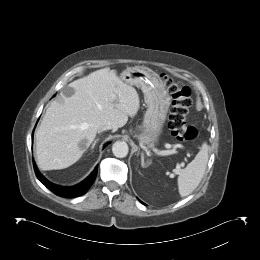 Adult ileal intussusception with secondary obstruction (Radiopaedia 30395-31051 Axial C+ portal venous phase 14).jpg