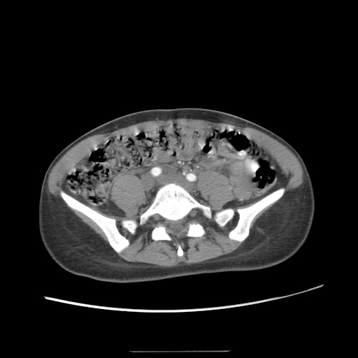 Adult polycystic kidney disease (Radiopaedia 48845-53876 Axial renal cortical phase 51).jpg
