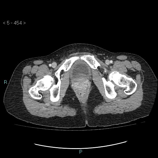 Adult transient intestinal intussusception (Radiopaedia 34853-36310 Axial C+ portal venous phase 122).jpg