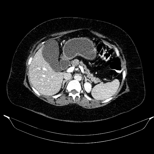 Afferent loop syndrome - secondary to incarcerated trocar site hernia (Radiopaedia 82959-97305 Axial C+ portal venous phase 72).jpg