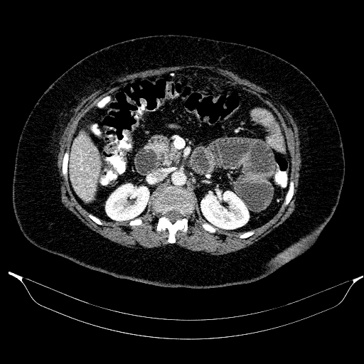 File:Afferent loop syndrome - secondary to incarcerated trocar site hernia (Radiopaedia 82959-97305 Axial C+ portal venous phase 91).jpg