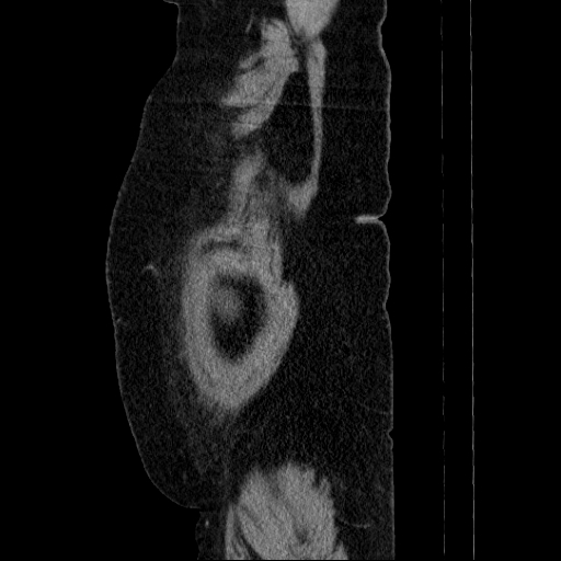 Afferent loop syndrome - secondary to incarcerated trocar site hernia (Radiopaedia 82959-97305 Sagittal C+ portal venous phase 6).jpg