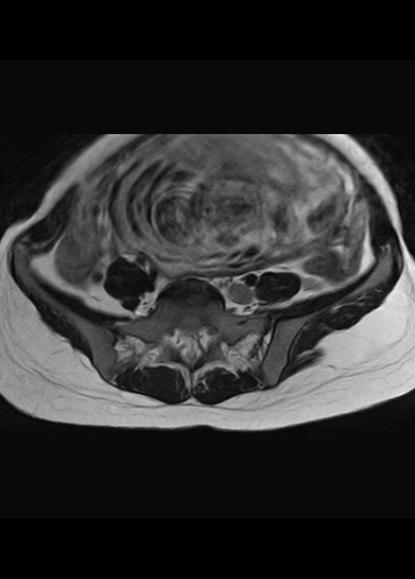 File:Aggressive angiomyxoma of the pelvis and perineum (Radiopaedia 59162-66479 Axial T2 24).jpg
