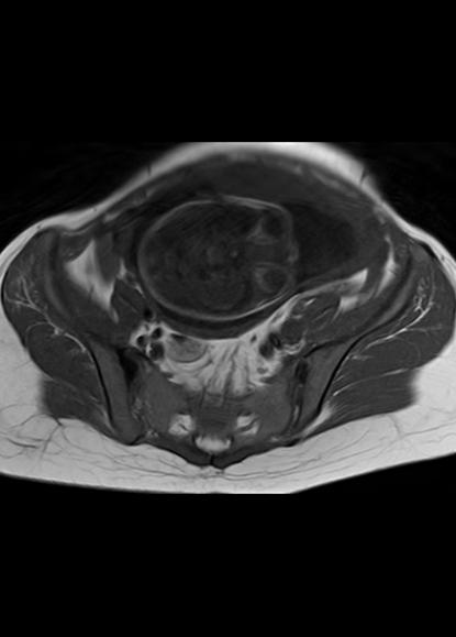 File:Aggressive angiomyxoma of the pelvis and perineum (Radiopaedia 59162-66479 T1 21).jpg