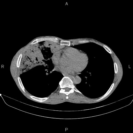 Air bronchogram in pneumonia (Radiopaedia 85719-101512 Axial non-contrast 41).jpg