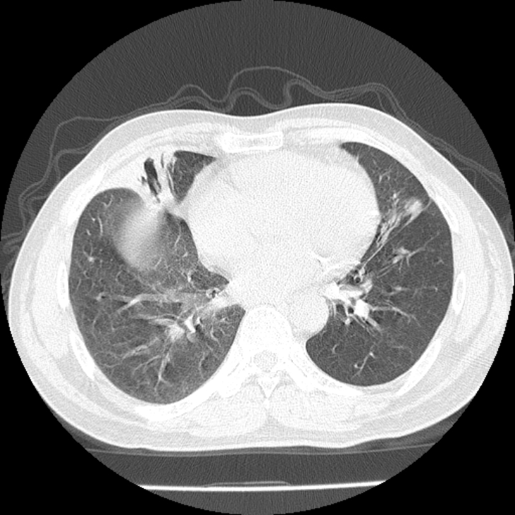 Airway foreign body in adult (Radiopaedia 85907-101779 Axial lung window 119).jpg