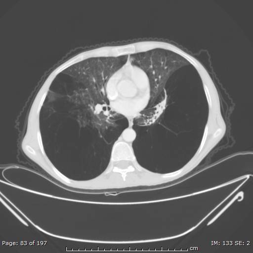 Alpha-1-antitrypsin deficiency (Radiopaedia 50561-55987 Axial lung window 35).jpg