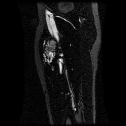 Alveolar soft part sarcoma (Radiopaedia 64501-73678 D 57).jpg
