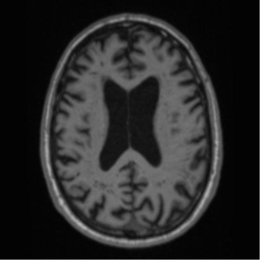 Alzheimer's disease- with Gerstmann syndrome and dressing apraxia (Radiopaedia 54882-61150 Axial T1 47).png