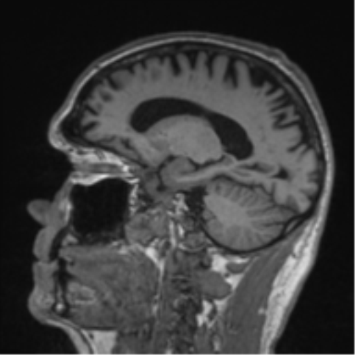 File:Alzheimer's disease- with Gerstmann syndrome and dressing apraxia (Radiopaedia 54882-61150 Sagittal T1 25).png
