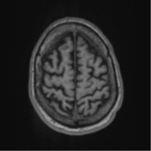 File:Alzheimer's disease- with apraxia (Radiopaedia 54763-61011 Axial T1 63).png