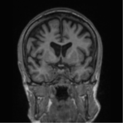 File:Alzheimer's disease- with apraxia (Radiopaedia 54763-61011 Coronal T1 58).png