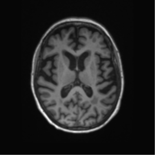 Alzheimer's disease (Radiopaedia 42658-45802 Axial T1 73).png