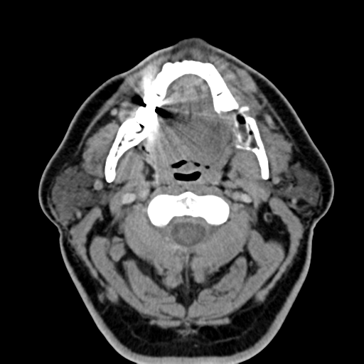 Ameloblastoma (Radiopaedia 38520-40623 Axial non-contrast 29).png