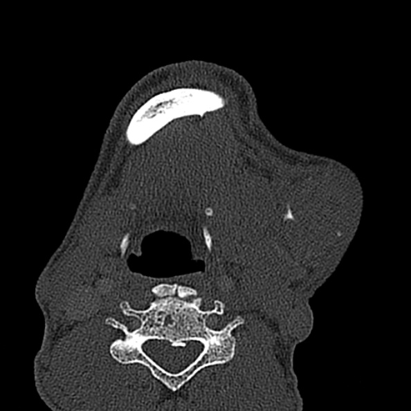 Ameloblastoma (Radiopaedia 51921-57766 Axial bone window 22).jpg