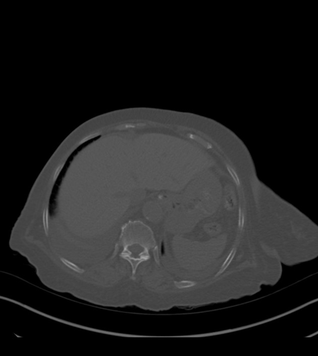 Amiodarone deposition in the liver (Radiopaedia 77587-89780 Axial bone window 72).jpg